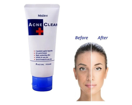 MISTINE Очищающая пенка для профилактики акне Acne Clear, 85 мл